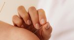 Acupuncture