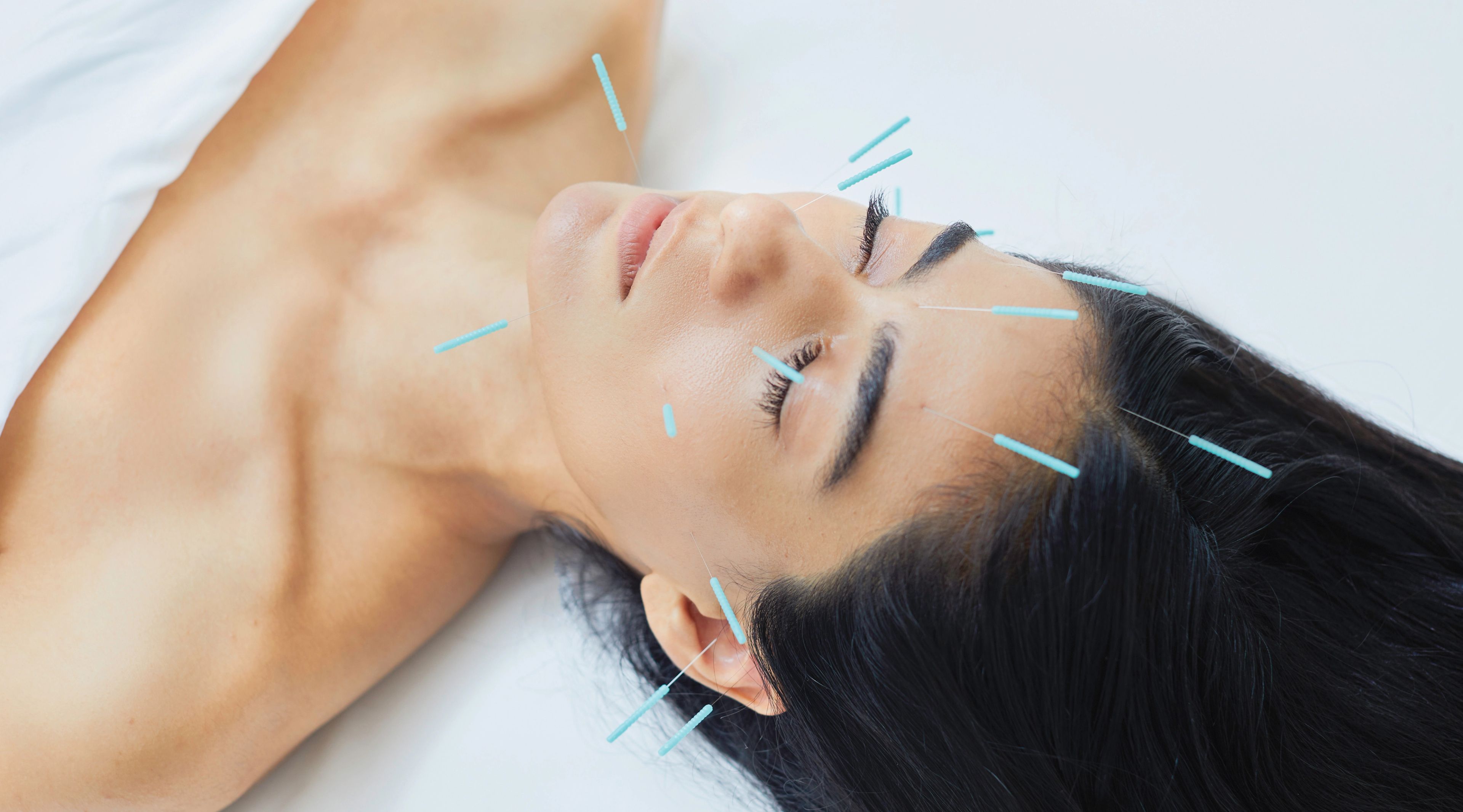 Acupuncture Services at THE WELL Bay Harbor Islands | Wellness Club in Miami
