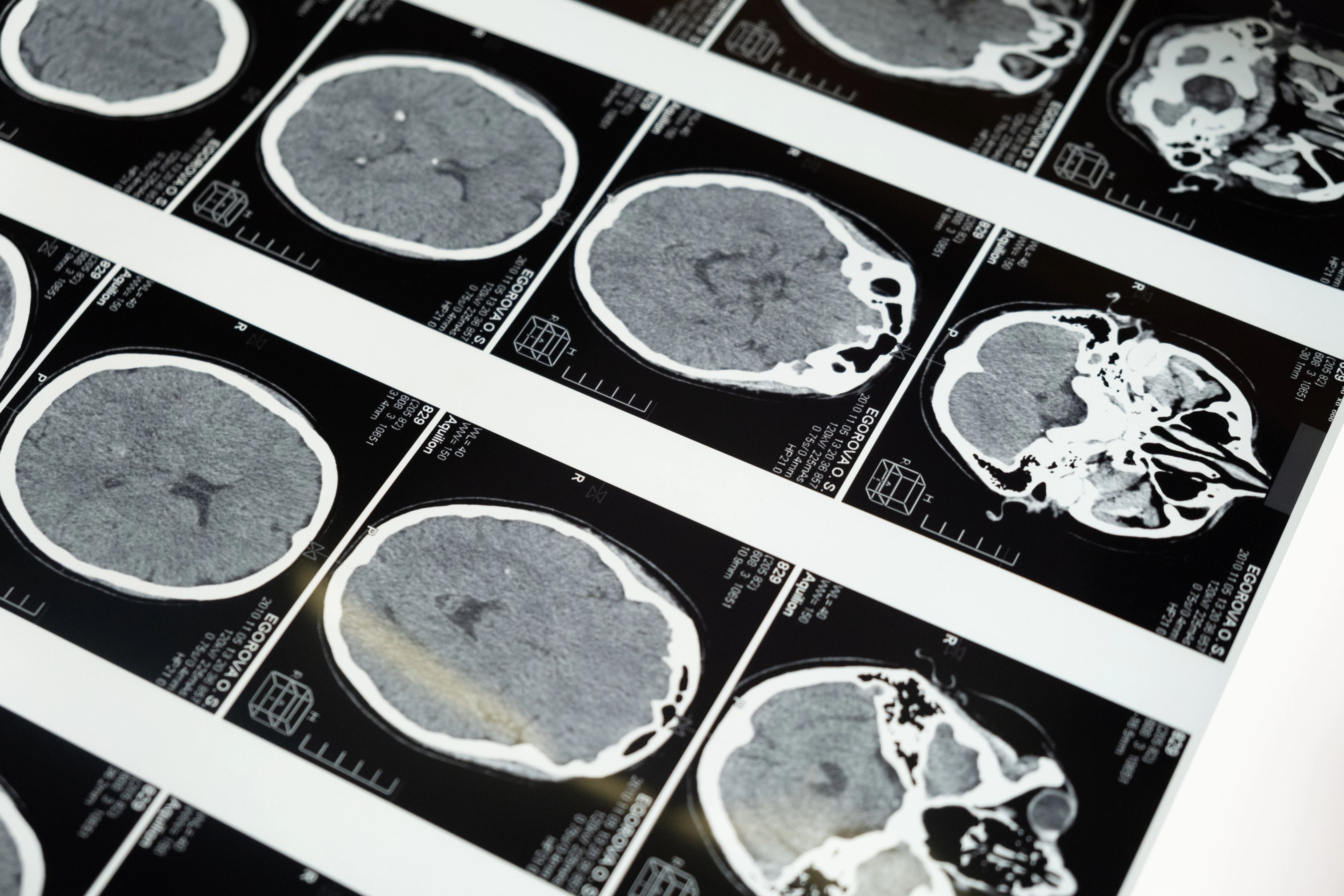 Black and white chart of brain scans